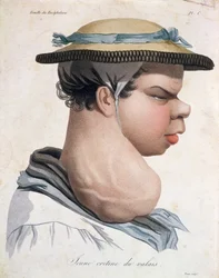 Jeune crétin du Valais, illustration d